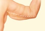 Arm Lift Incision Placement 