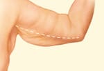 Arm Lift Surgery Incision Line