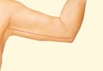 Arm lift resulting scar placmeent