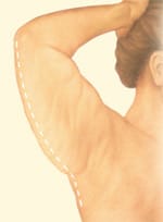 Extended arm lift incision design