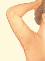 Extended arm lift resulting scar