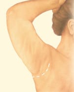Short scar arm lift incision placement