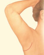 Short Scar Arm Lift Resulting Scar