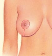 Vertical Breast Lift Scar