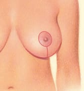 Wise Pattern Mastopexy Scars