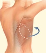 Latissimus flap technique