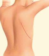 Latissimus flap back scar