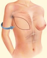 Latissimus flap technqiue2