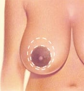 Circumareolar Reduction