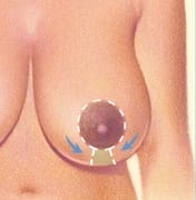 Vertical Reduction Mammaplasty