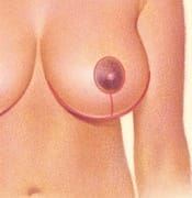 Wise pattern breast reduction scar
