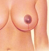 Wise pattern reduction scar