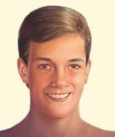 Prominent Ear Otoplasty Results