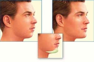 Chin Implant Effect