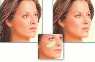 Malar Implant Effect