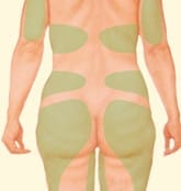 Circumferential Liposuction target area