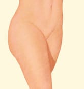 Lateral thigh liposuction result