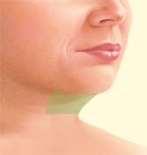 Submental Liposuction target area
