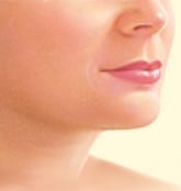 Submental liposuction result