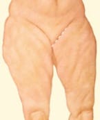 Medial thigh lift incisions