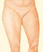 Medial thigh lift scars