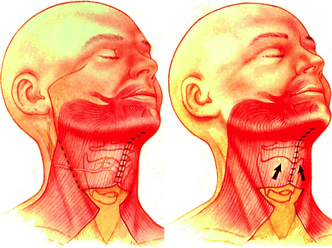 Full facelift neck procedure