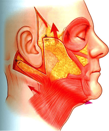 SMAS flap facelift