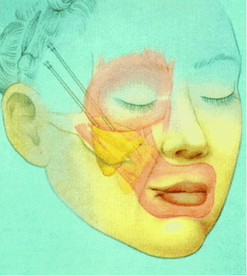 Endoscopic Midface Lift