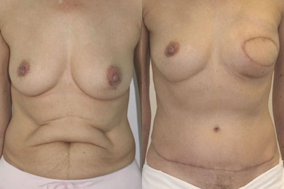 Left Breast DIEP Flap Breast Reconstruction by Dr. Thomassen