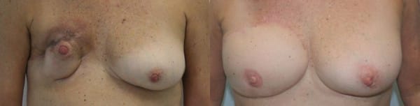Right Breast DIEP Flap Breast Reconstruction by Dr. Thomassen