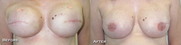 Bilateral Staged  Tissue Expander - Implant Breast Reconstruction with Nipple Reconstruction and Areolar Tattoo by Dr. Thomassen
