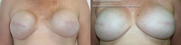 Bilateral Exchange of Expanders to Implants after Bilateral Mastectomy by Dr. Thomassen