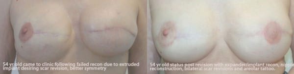 Exchange of Expander to Implant after Bilateral Mastectomy with Nipple Sparing procedure on the R and Nipple Reconstruction with Areolar Tattoo on the Left by Dr. Thomassen