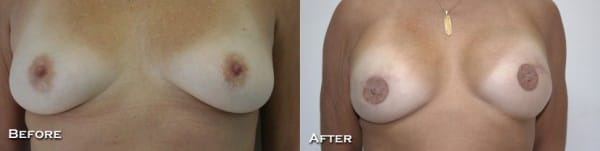 Bilateral Breast Reconstruction with Staged Expander - Implant, Nipple Reconstruction, and Areolar Tattoo by Dr. Thomassen