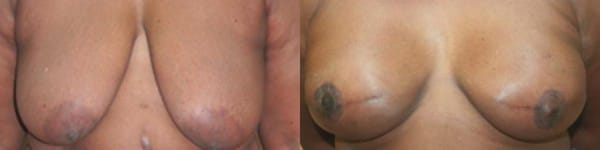 Bilateral Breast Reconstruction with Staged Expander - Implant, Nipple Reconstruction and Areolar Tattoo by Dr. Thomassen