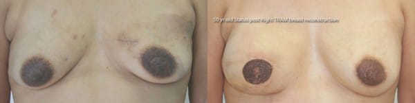 Right TRAM Flap Breast Reconstruction by Dr. Thomassen