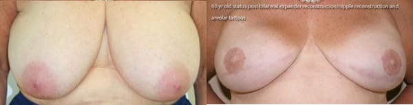 Bilateral Breast Reconstruction with Staged Expander - Implant, Nipple Reconstruction, and Areolar Tattoo by Dr. Thomassen