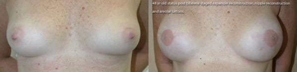 Bilateral Breast Reconstruction with Staged Expander - Implants, Nipple Reconstruction and Areolar Tatoo by Dr. Thomassen