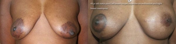 Unilateral Left Breast Reconstruction with Staged Expander - Implant, Nipple Reconstruction, and Areolar Tattoo and Matching Procedure on Right side with an Augmentation Mastopexy by Dr. Thomassen