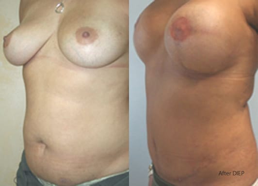 Left Breast DIEP Flap Breast Reconstruction by Dr. Thomassen