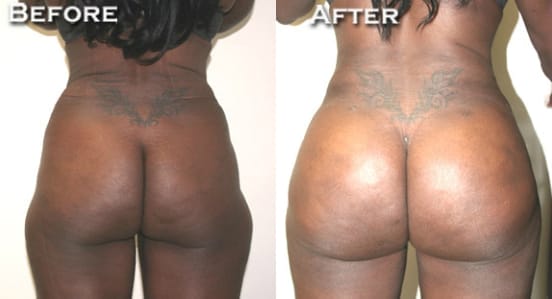 Tummy Tuck (Abdominoplasty) by Dr. Thomassen in Fort Lauderdale