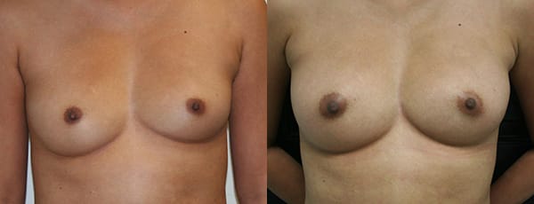 Fat Grafting to Breasts by Dr. Thomassen in Fort Lauderdale