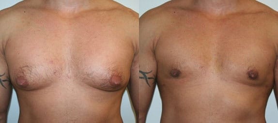 Male Breast Reduction Before After 1a Gynecomastia Correction by Dr. Thomassen