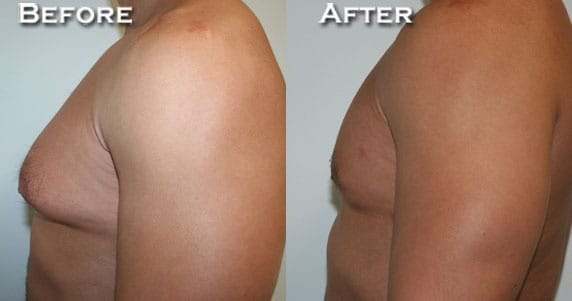 Gynecomastia Correction by Dr. Thomassen