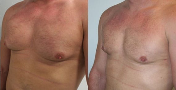 Male Breast Reduction Before After 2b Gynecomastia Correction by Dr. Thomassen