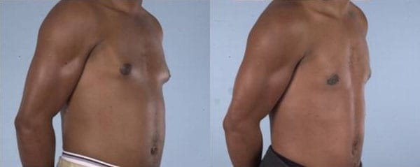 Gynecomastia Correction by Dr. Thomassen