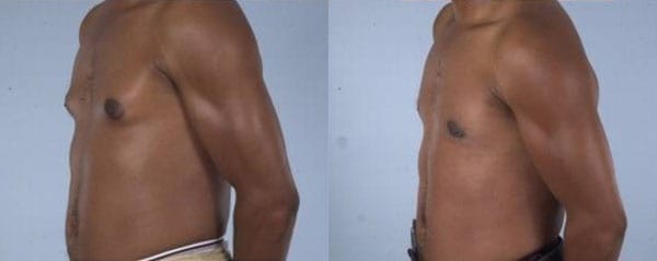 Gynecomastia Correction by Dr. Thomassen