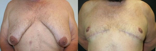 Gynecomastia Correction by Dr. Thomassen