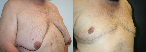 Male Breast Reduction Before After 6b Gynecomastia Correction by Dr. Thomassen