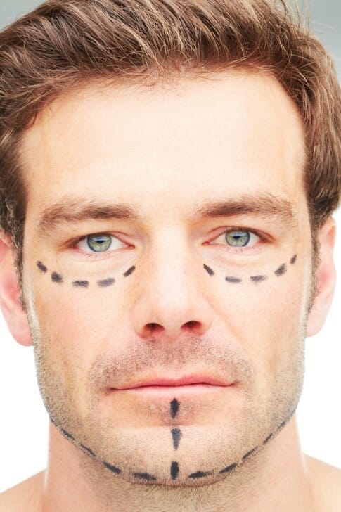 Featured image for “Male Facelift”